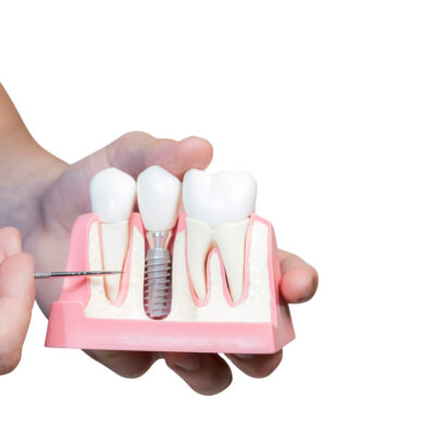 Dental Implant Cost: Instant Ways to Save on Dental Implants