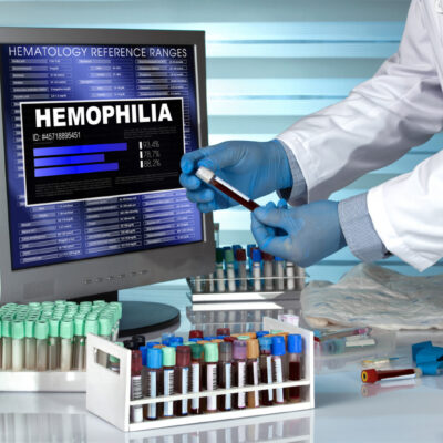 5 Common Symptoms of Hemophilia